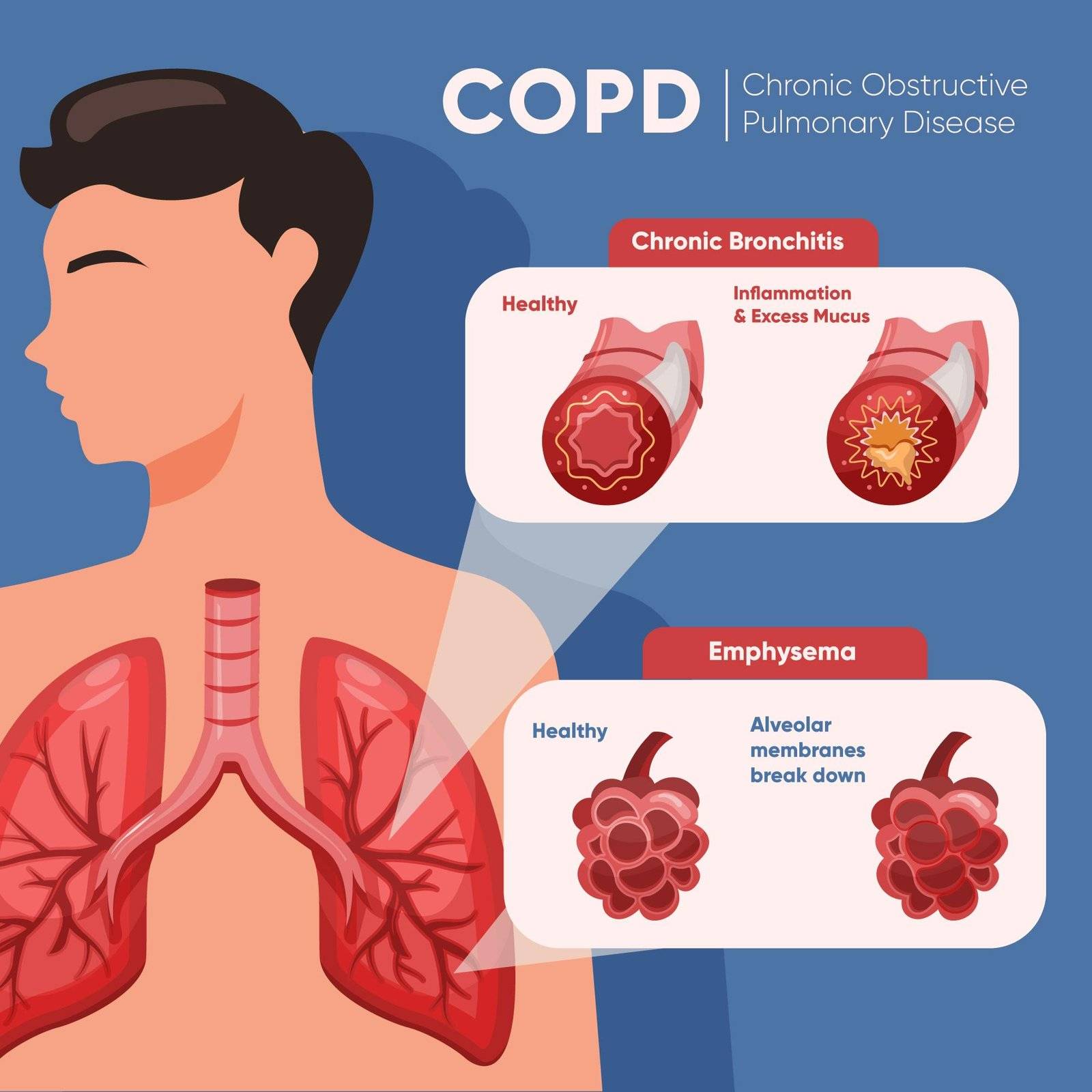 Understanding COPD Stages: When is Medical Oxygen Therapy Required?